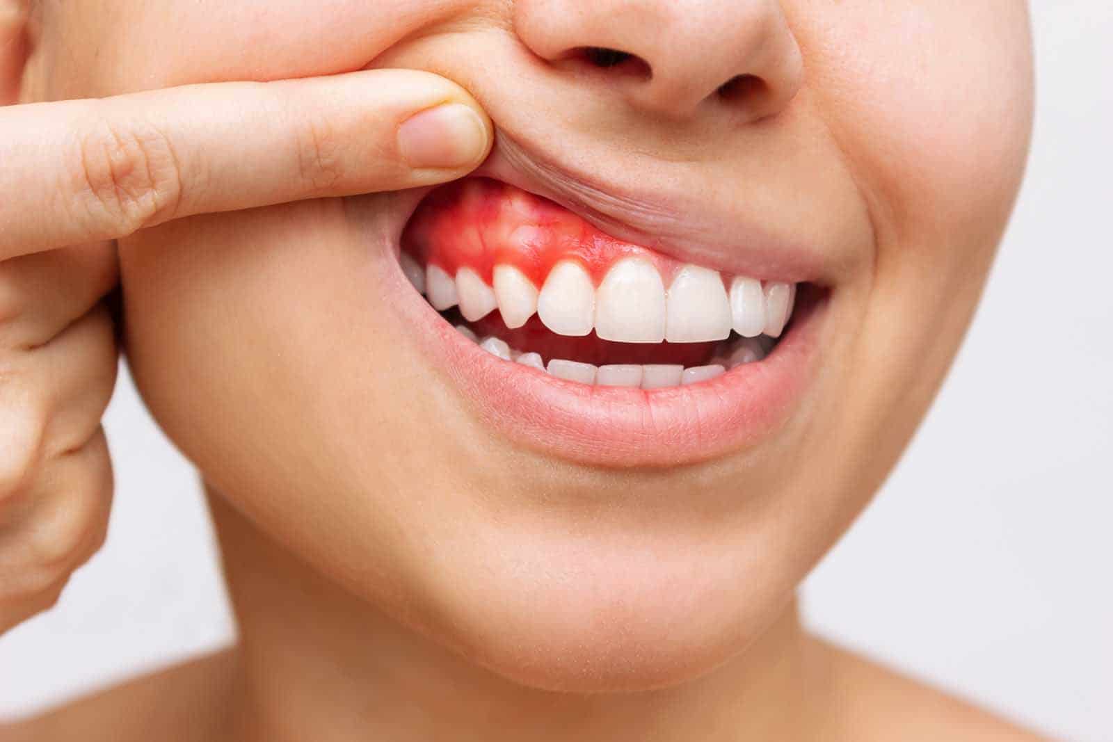 Diş Eti Kanaması Normal midir? Yoksa Tedavi Gerektirir mi?livaclinic